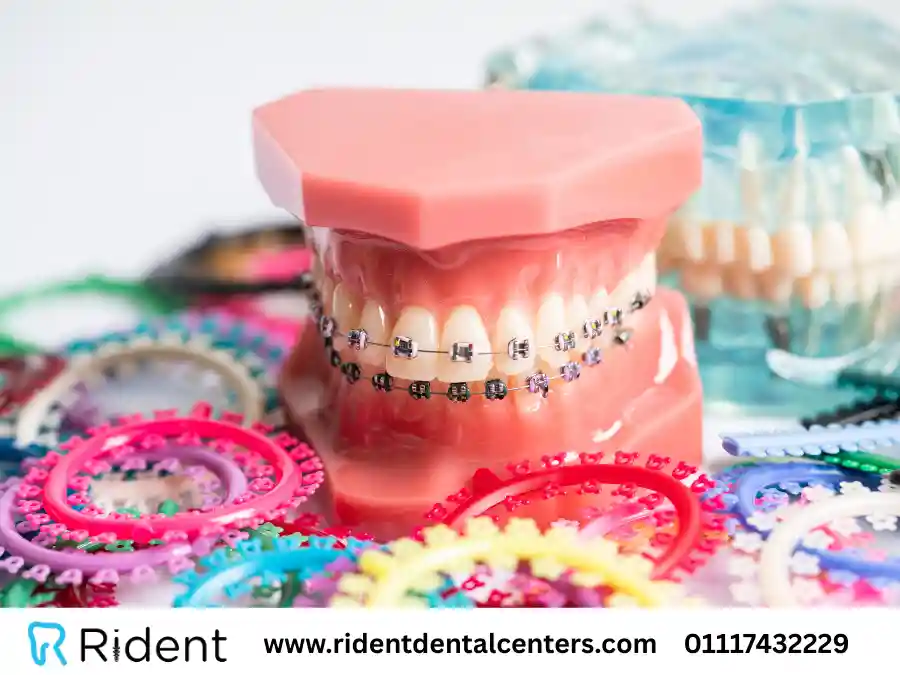 اسعار تقويم الاسنان